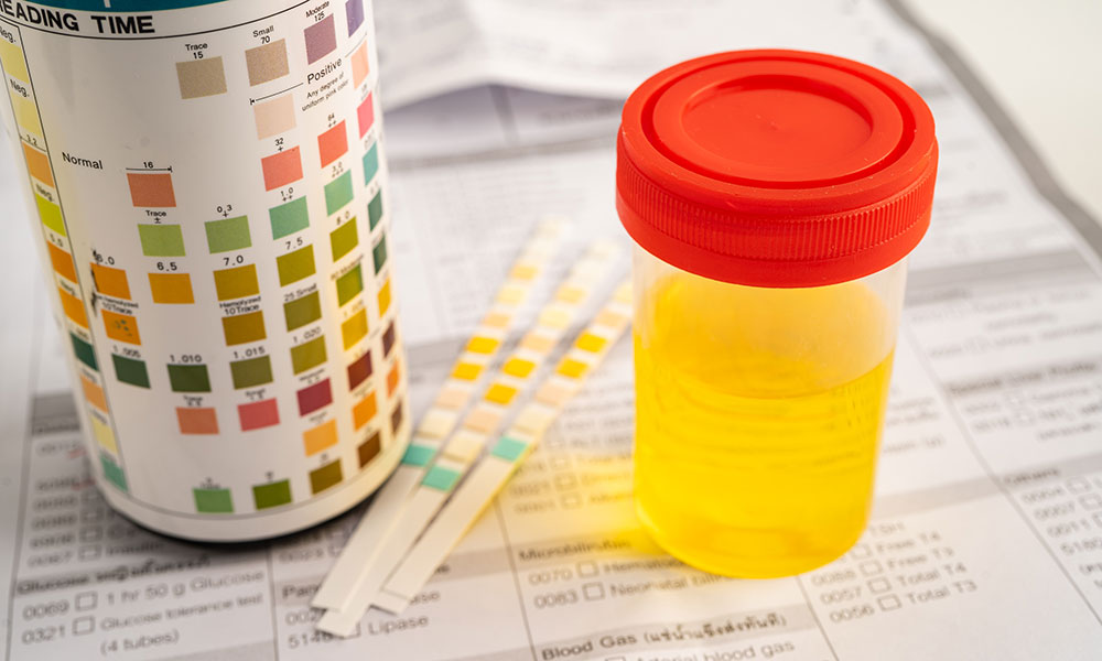 alprazolam and its metabolites tend to be detectable in urine